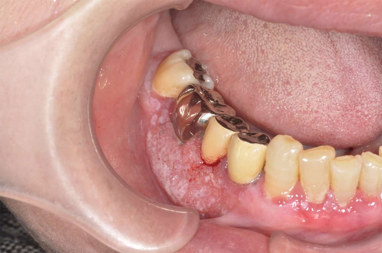 口腔がんの診断にはどのような生検が役立ちますか?
