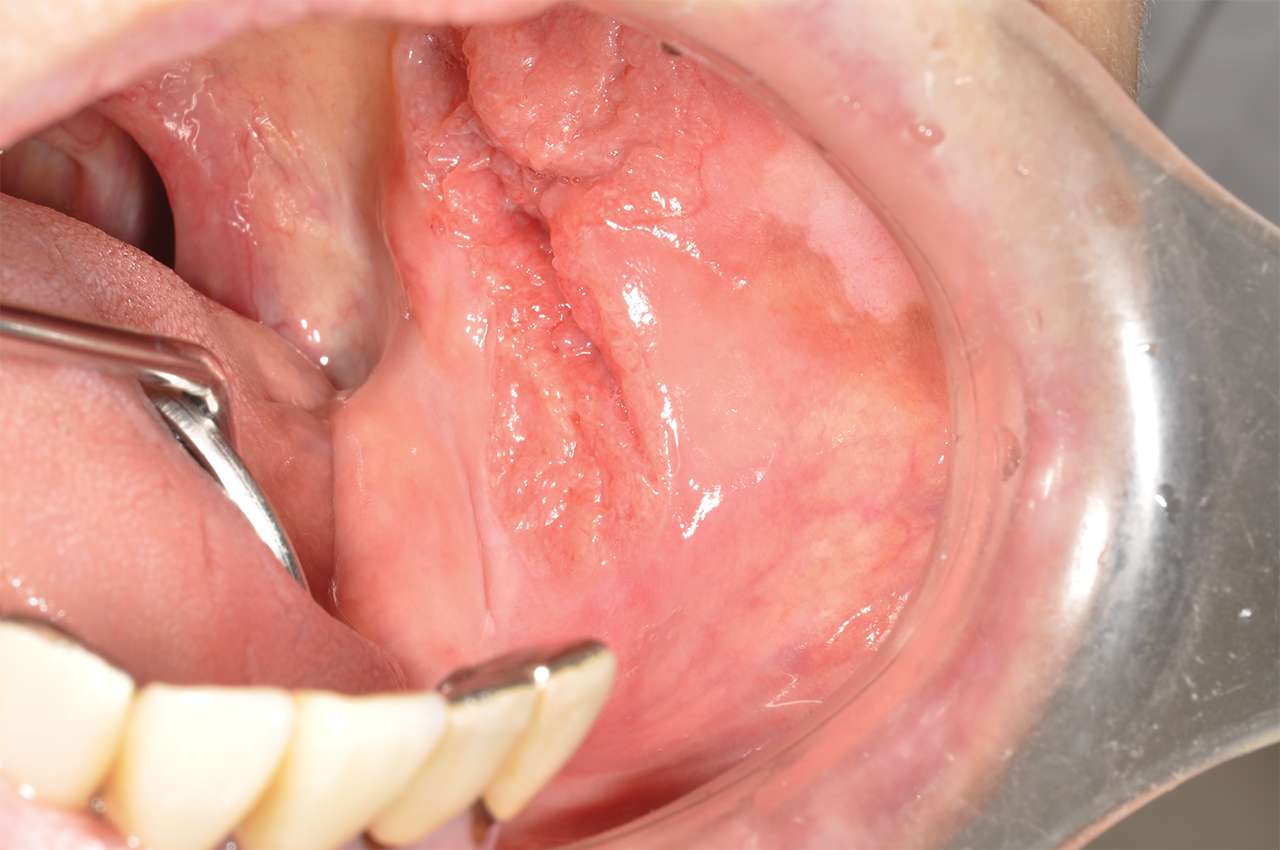 口腔がん 舌癌は歯科口腔外科で検査することができます まつばら歯科口腔外科こども歯科