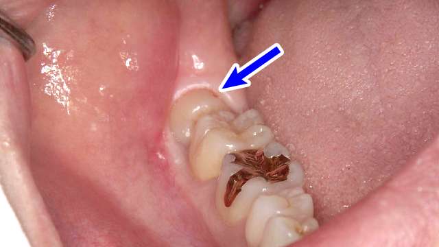 親知らず 抜歯 後 上 の 歯 が 痛い