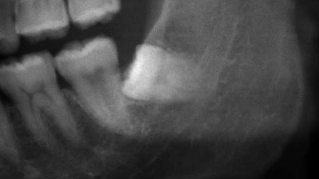 根っこが下顎管に接触している親知らずのレントゲン写真